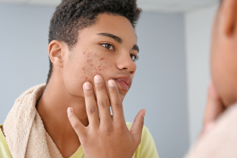 Teenage boy with acne touching his cheek